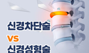 허리 통증, 어떤 치료가 나에게 맞을까? 🤔 신경성형술 VS 신경차단술 완벽 비교!